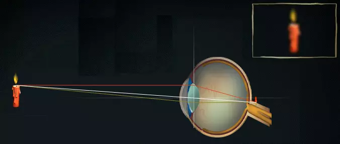 Причина дальнозоркости - уменьшенное глазное яблоко